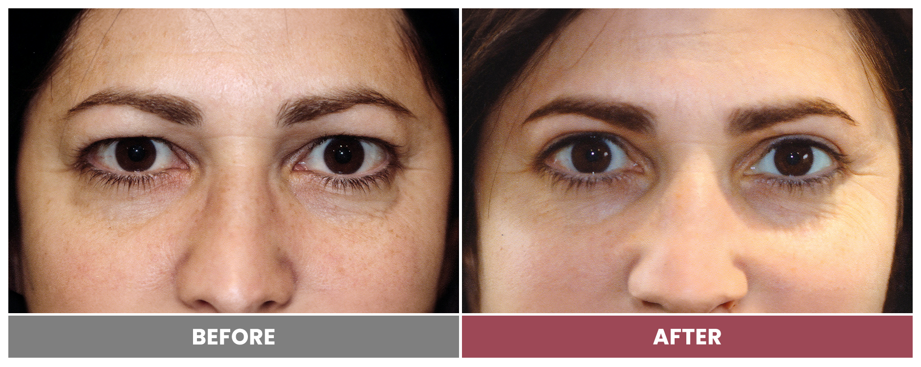Upper Blepharoplasty - Case 44